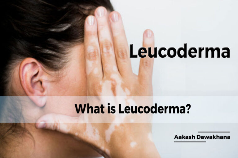 What-is-Leucoderma